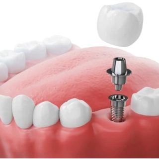dental implants