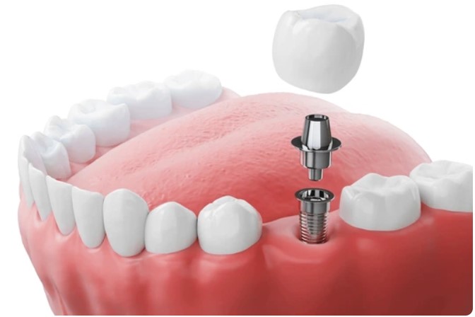 dental implants
