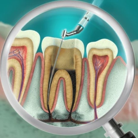 endodontics