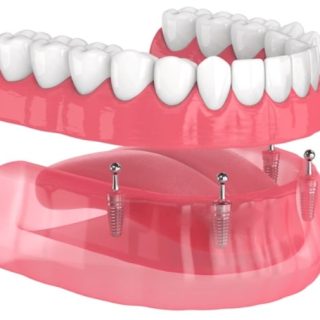 implant supported dentures locators
