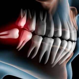 wisdom tooth pain