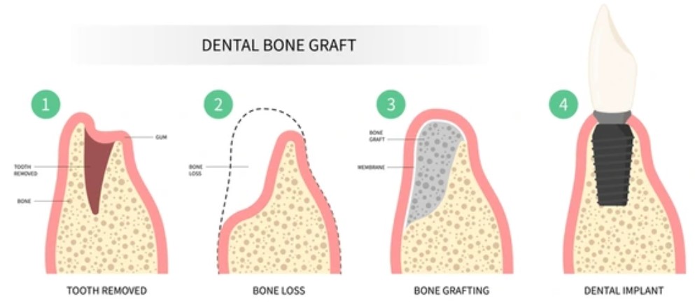 Bone graft and implant process https://ottawadentalcare.ca/wp-content/uploads/2025/10/Bone-graft-and-implant-process.jpg