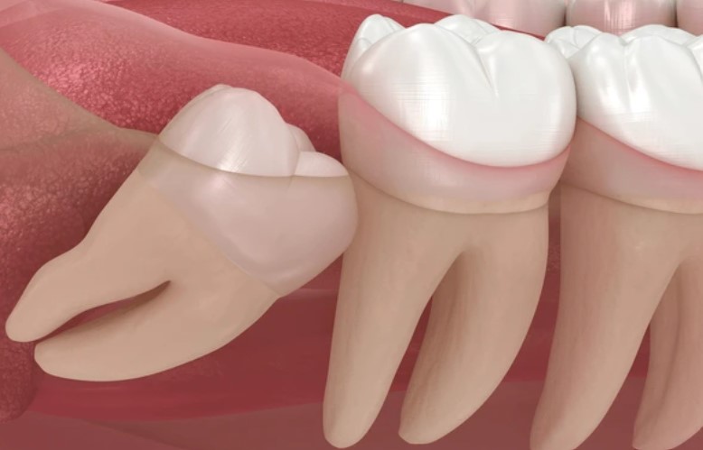 oral surgery molar impaction https://ottawadentalcare.ca/wp-content/uploads/2025/10/oral-surgery-molar-impaction.jpg