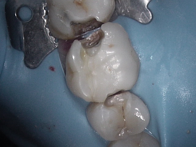 rubberdam cavity prep https://ottawadentalcare.ca/wp-content/uploads/2025/10/rubberdam-cavity-prep.jpg