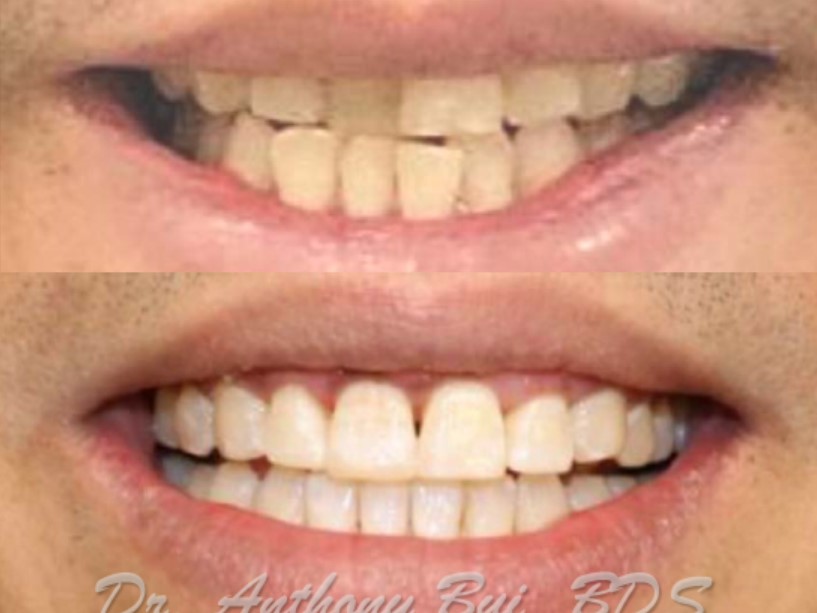 Smile Makeover Bui C