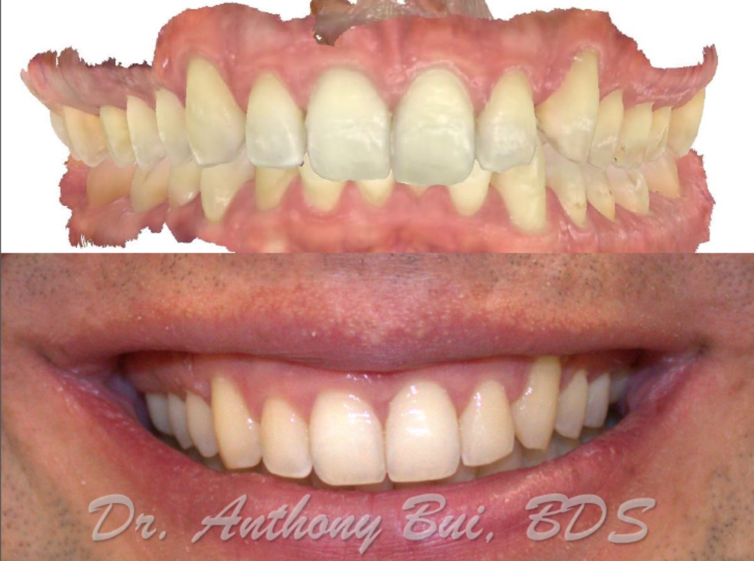 Smile Makeover Hiscocks